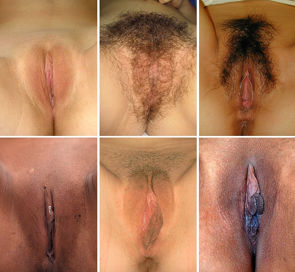 Contoh Keragaman Bentuk Vulva